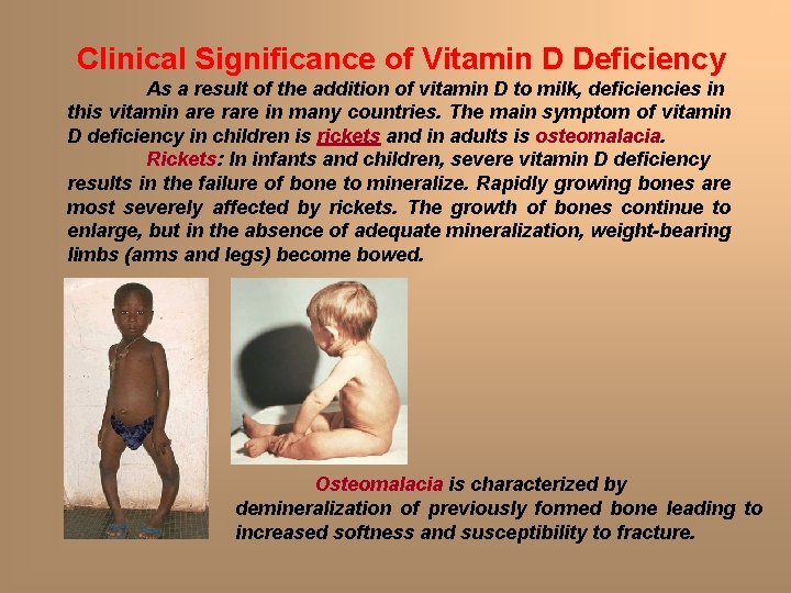 Clinical Significance of Vitamin D Deficiency As a result of the addition of vitamin Clinical Significance of Vitamin D Deficiency As a result of the addition of vitamin