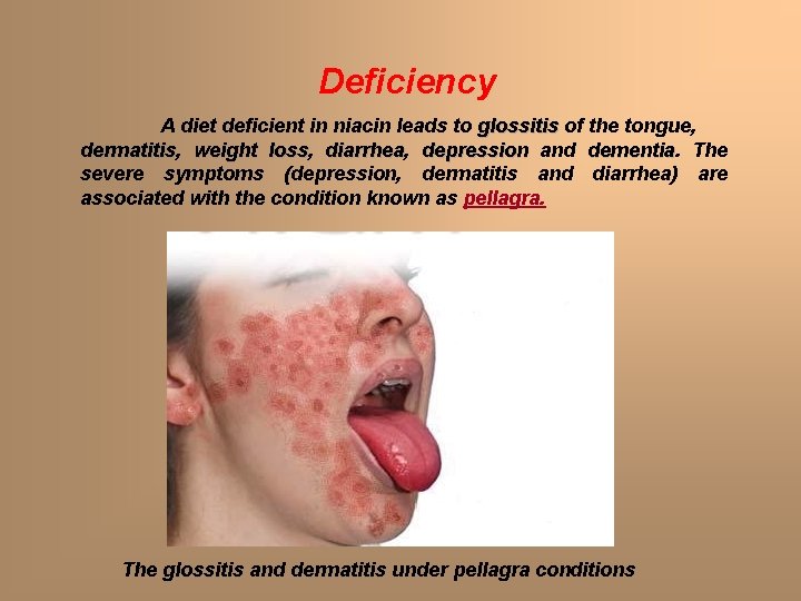 Deficiency A diet deficient in niacin leads to glossitis of the tongue, dermatitis weight Deficiency A diet deficient in niacin leads to glossitis of the tongue, dermatitis weight