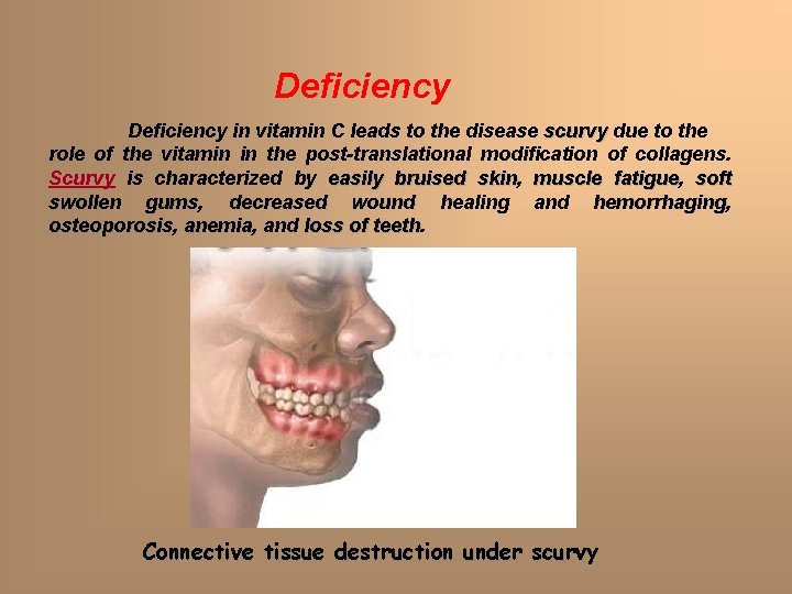 Deficiency in vitamin C leads to the disease scurvy due to the role of Deficiency in vitamin C leads to the disease scurvy due to the role of
