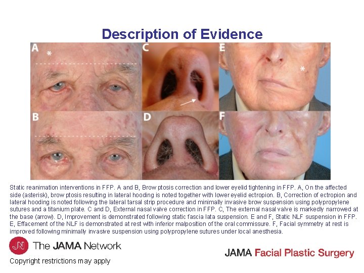Description of Evidence Static reanimation interventions in FFP. A and B, Brow ptosis correction