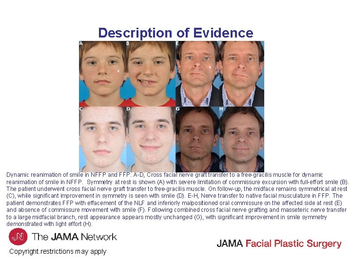Description of Evidence Dynamic reanimation of smile in NFFP and FFP. A D, Cross