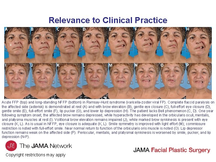 Relevance to Clinical Practice Acute FFP (top) and long standing NFFP (bottom) in Ramsay