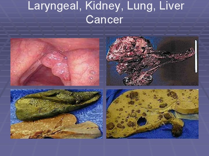 Laryngeal, Kidney, Lung, Liver Cancer 