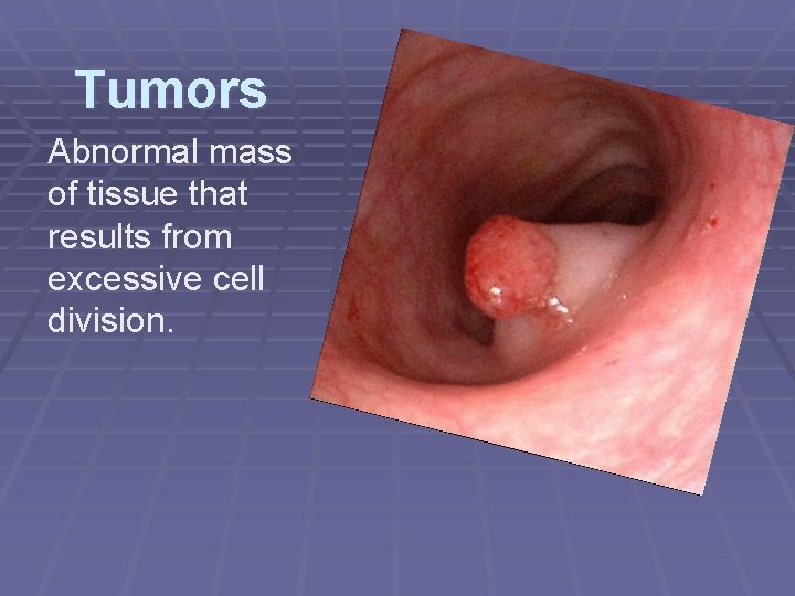 Tumors Abnormal mass of tissue that results from excessive cell division. 