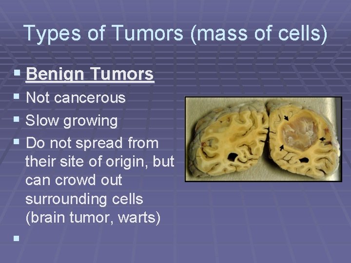 Types of Tumors (mass of cells) § Benign Tumors § Not cancerous § Slow