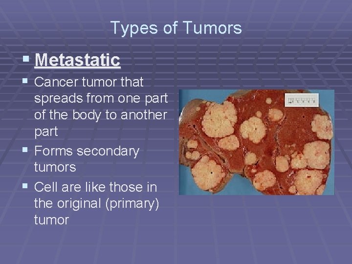 Types of Tumors § Metastatic § Cancer tumor that spreads from one part of