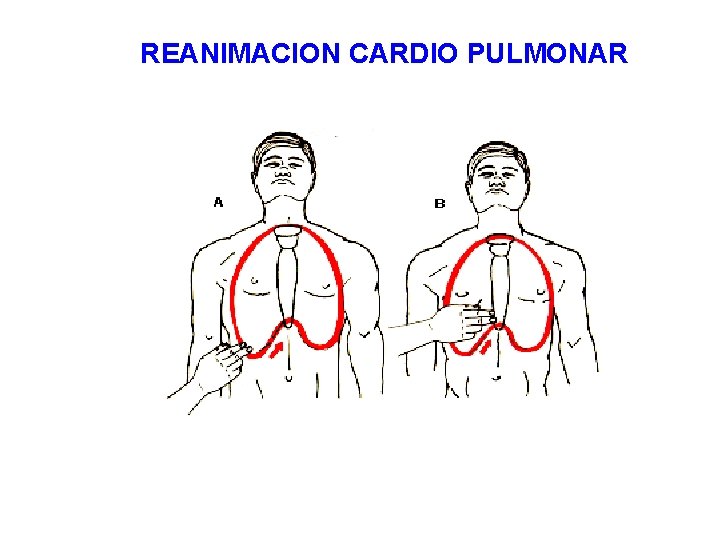 REANIMACION CARDIO PULMONAR 