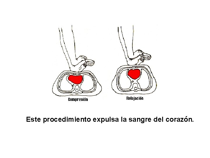 Este procedimiento expulsa la sangre del corazón. 