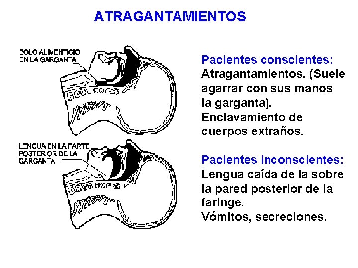 ATRAGANTAMIENTOS Pacientes conscientes: Atragantamientos. (Suele agarrar con sus manos la garganta). Enclavamiento de cuerpos