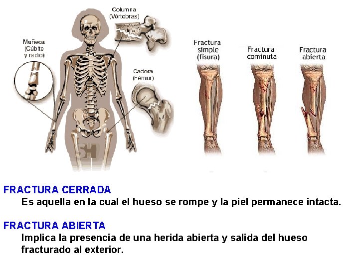 FRACTURA CERRADA Es aquella en la cual el hueso se rompe y la piel