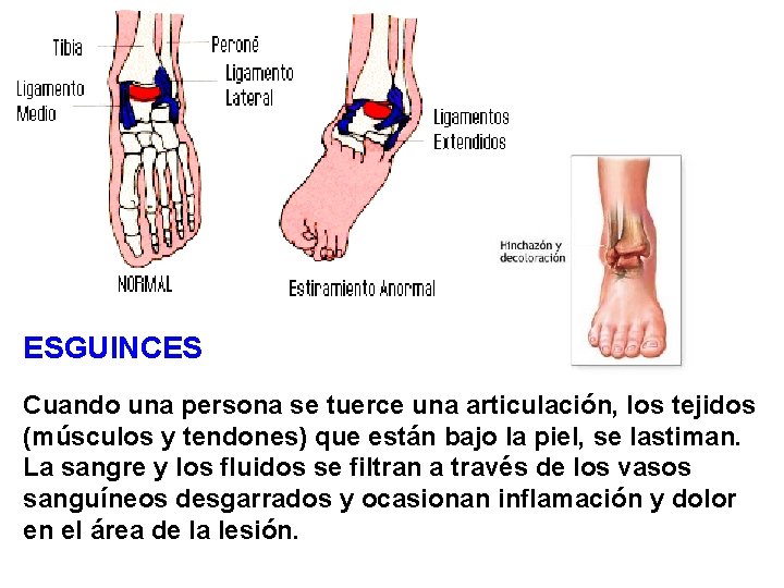 ESGUINCES Cuando una persona se tuerce una articulación, los tejidos (músculos y tendones) que