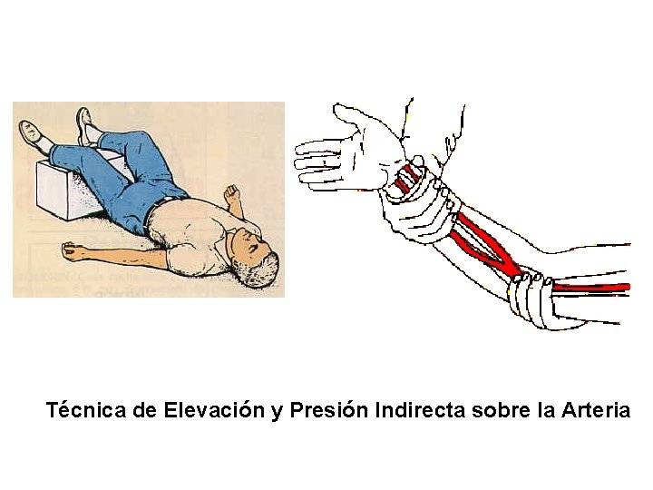 Técnica de Elevación y Presión Indirecta sobre la Arteria 