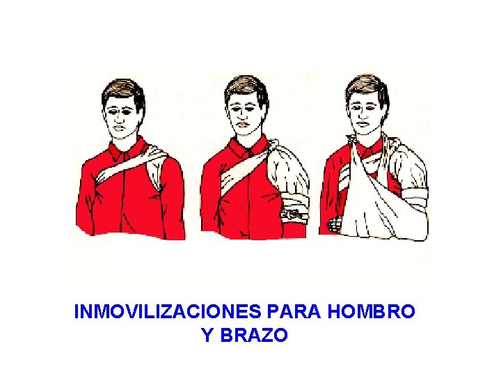 INMOVILIZACIONES PARA HOMBRO Y BRAZO 