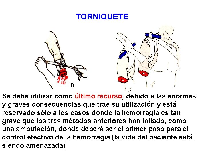 TORNIQUETE Se debe utilizar como último recurso, debido a las enormes y graves consecuencias