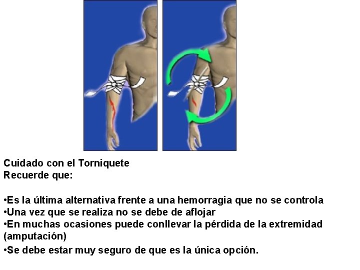 Cuidado con el Torniquete Recuerde que: • Es la última alternativa frente a una