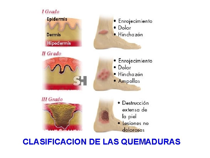 CLASIFICACION DE LAS QUEMADURAS 