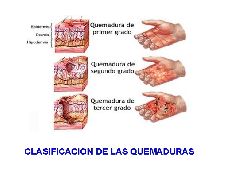 CLASIFICACION DE LAS QUEMADURAS 