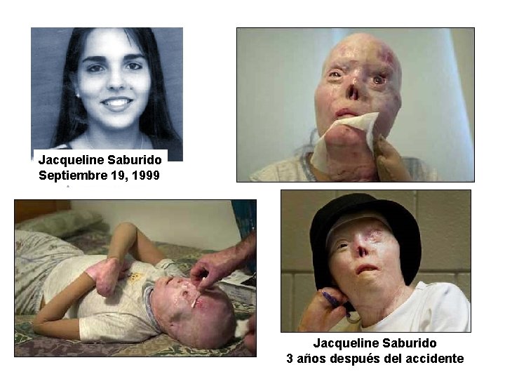 Jacqueline Saburido Septiembre 19, 1999 Jacqueline Saburido 3 años después del accidente 