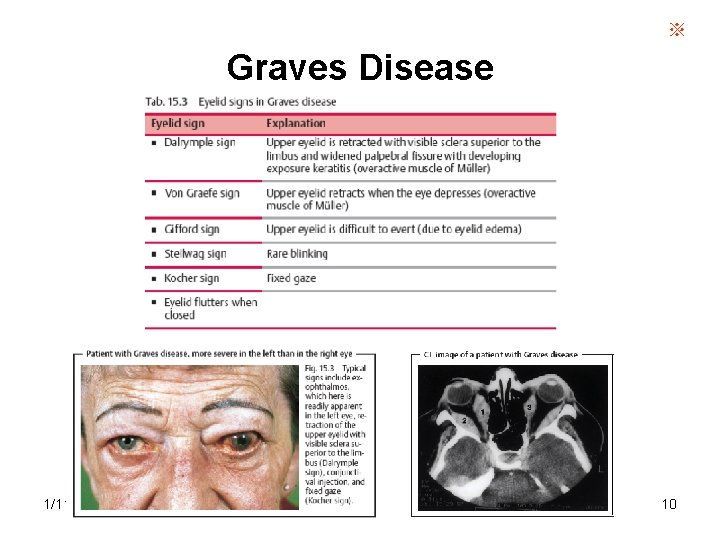 ※ Graves Disease 1/11/2022 10 