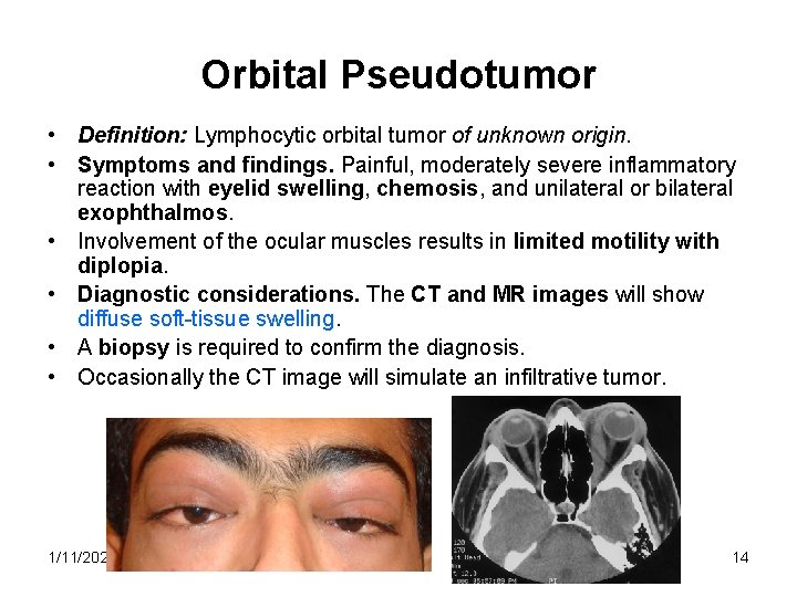 Orbital Pseudotumor • Definition: Lymphocytic orbital tumor of unknown origin. • Symptoms and findings.