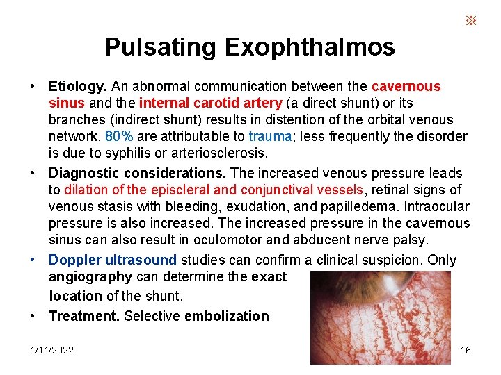 ※ Pulsating Exophthalmos • Etiology. An abnormal communication between the cavernous sinus and the