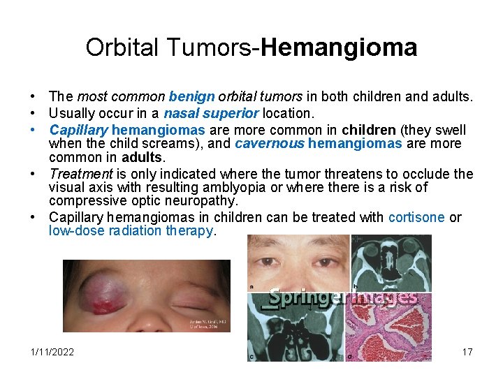 Orbital Tumors-Hemangioma • The most common benign orbital tumors in both children and adults.