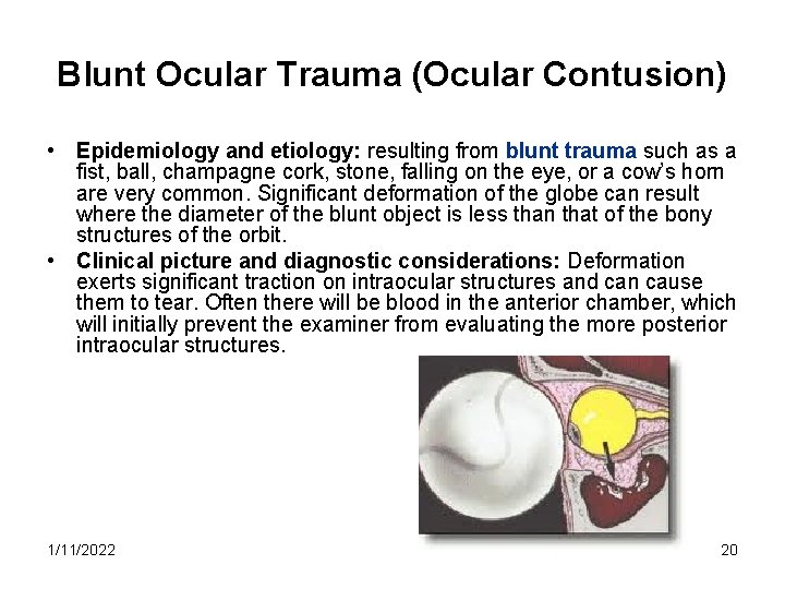 Blunt Ocular Trauma (Ocular Contusion) • Epidemiology and etiology: resulting from blunt trauma such