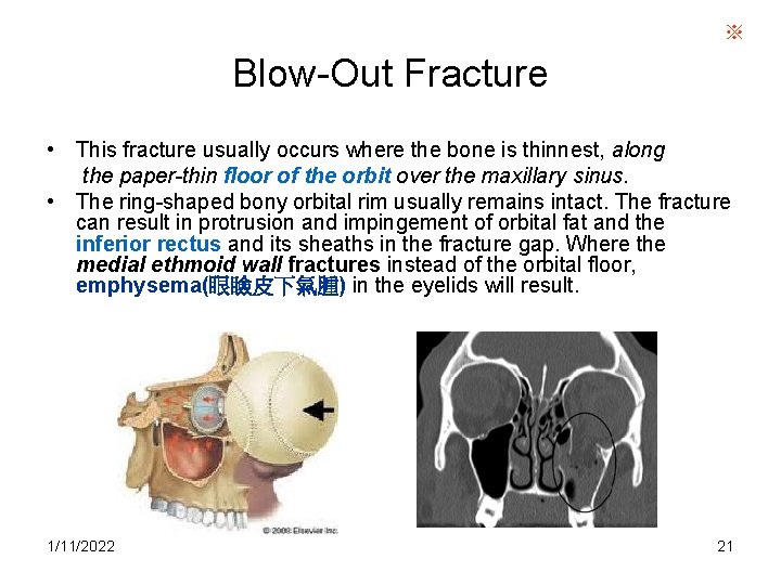 ※ Blow-Out Fracture • This fracture usually occurs where the bone is thinnest, along
