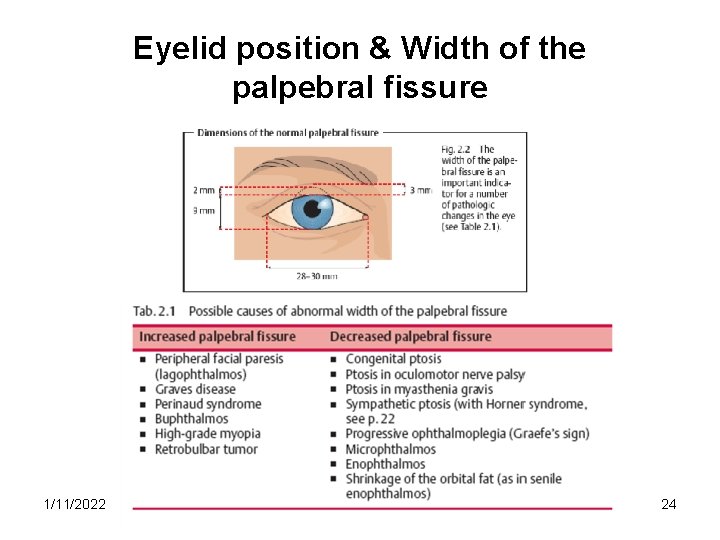 Eyelid position & Width of the palpebral fissure 1/11/2022 24 