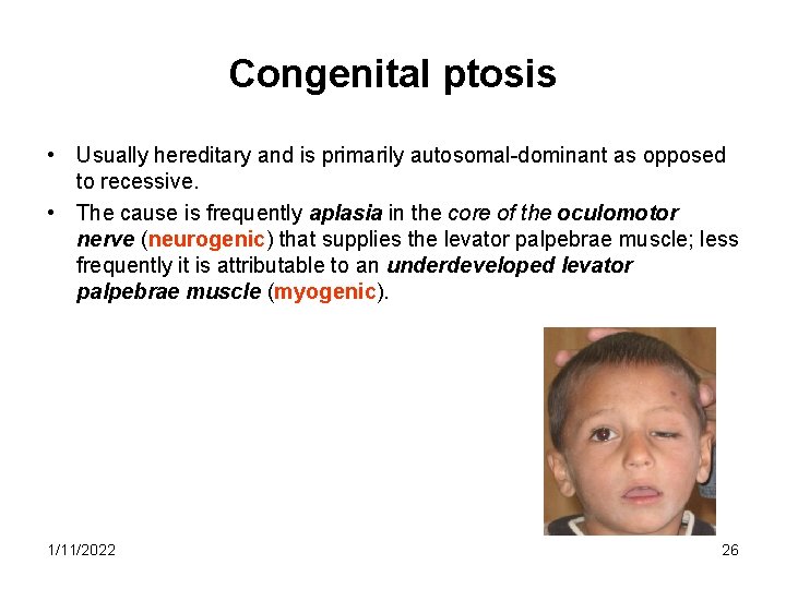 Congenital ptosis • Usually hereditary and is primarily autosomal-dominant as opposed to recessive. •