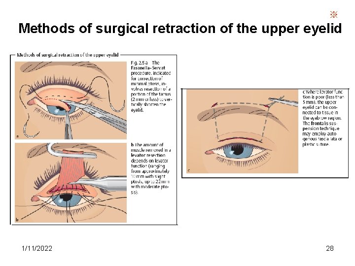 ※ Methods of surgical retraction of the upper eyelid 1/11/2022 28 