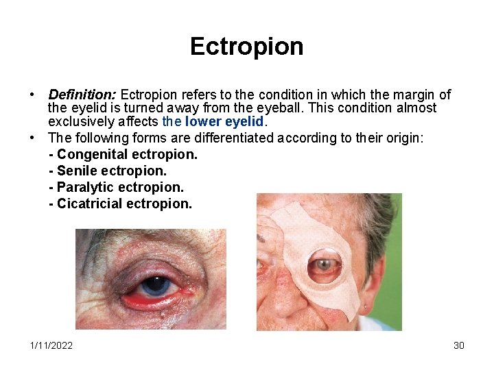 Ectropion • Definition: Ectropion refers to the condition in which the margin of the