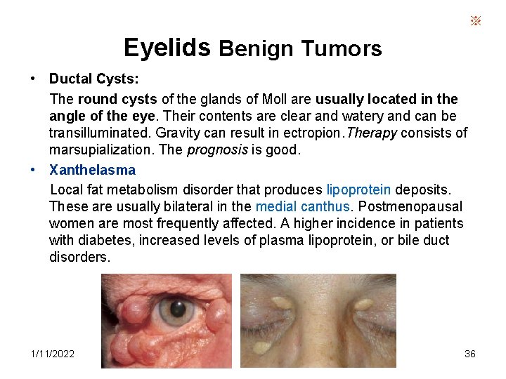 ※ Eyelids Benign Tumors • Ductal Cysts: The round cysts of the glands of