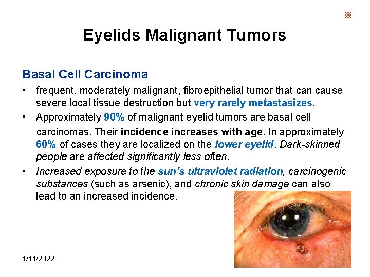 ※ Eyelids Malignant Tumors Basal Cell Carcinoma • frequent, moderately malignant, fibroepithelial tumor that