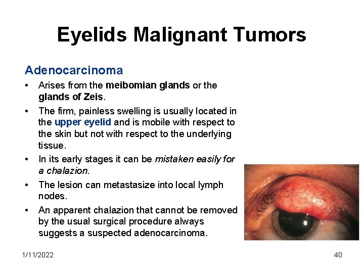 Eyelids Malignant Tumors Adenocarcinoma • • • Arises from the meibomian glands or the