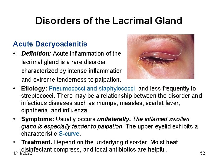 Disorders of the Lacrimal Gland Acute Dacryoadenitis • Definition: Acute inflammation of the lacrimal