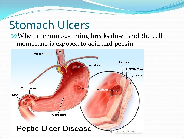 Stomach Ulcers When the mucous lining breaks down and the cell membrane is exposed