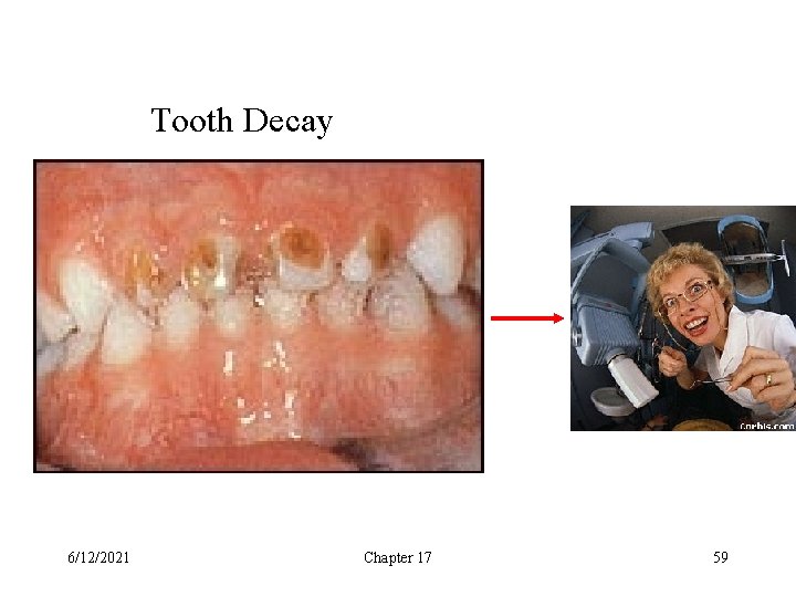 Tooth Decay 6/12/2021 Chapter 17 59 