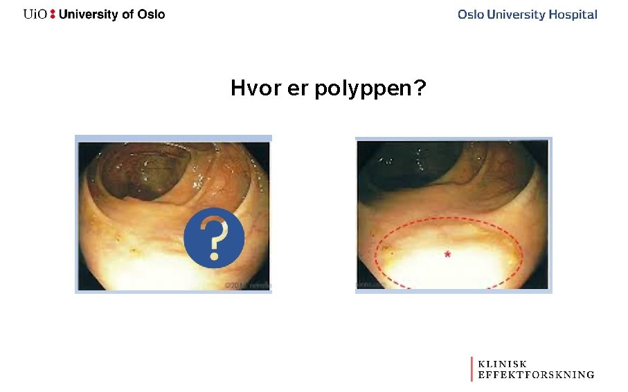 Hvor er polyppen? 