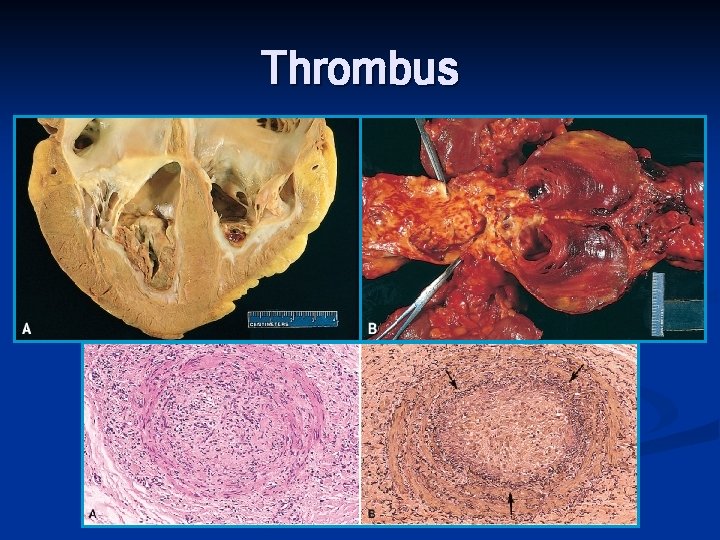 Thrombus 