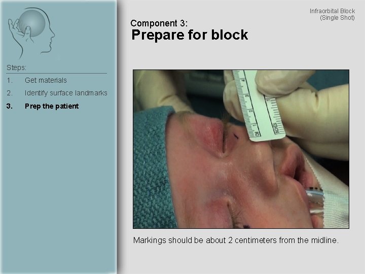 Component 3: Infraorbital Block (Single Shot) Prepare for block Steps: 1. Get materials 2.