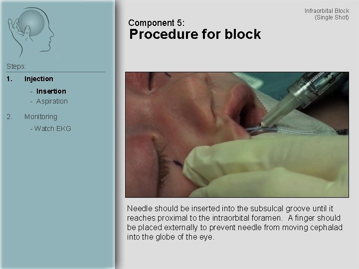 Component 5: Infraorbital Block (Single Shot) Procedure for block Steps: 1. Injection - Insertion