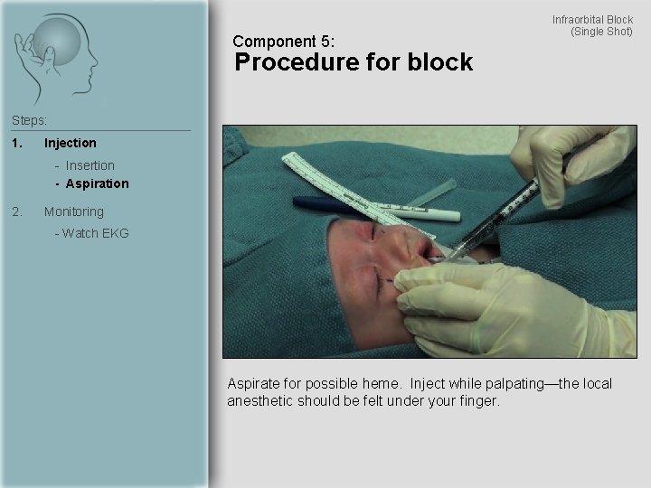 Component 5: Infraorbital Block (Single Shot) Procedure for block Steps: 1. Injection - Insertion