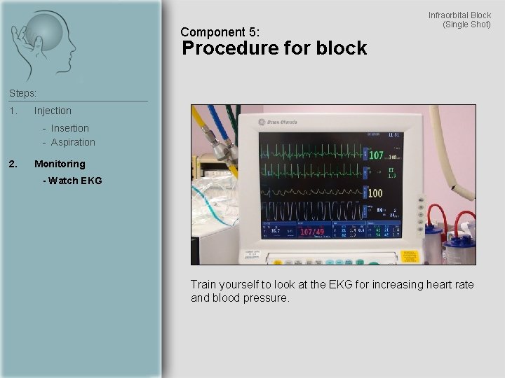 Component 5: Infraorbital Block (Single Shot) Procedure for block Steps: 1. Injection - Insertion
