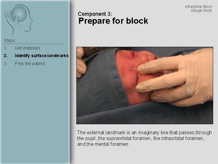 Component 3: Infraorbital Block (Single Shot) Prepare for block Steps: 1. Get materials 2.