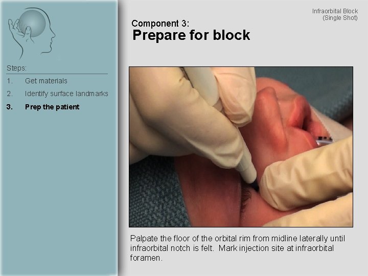 Component 3: Infraorbital Block (Single Shot) Prepare for block Steps: 1. Get materials 2.