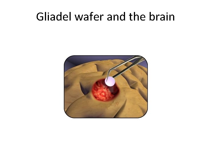 Gliadel wafer and the brain 