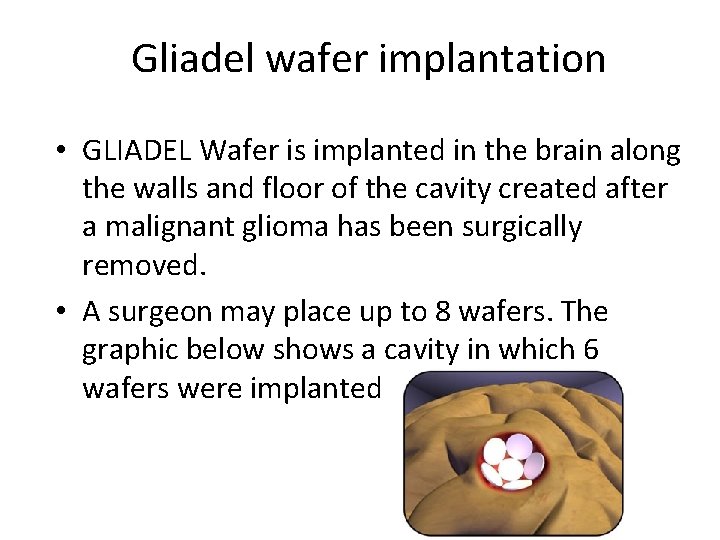 Gliadel wafer implantation • GLIADEL Wafer is implanted in the brain along the walls