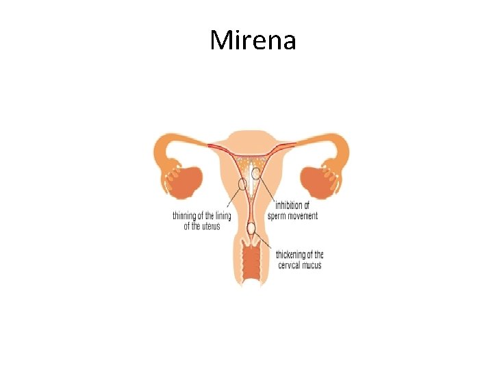 Mirena 