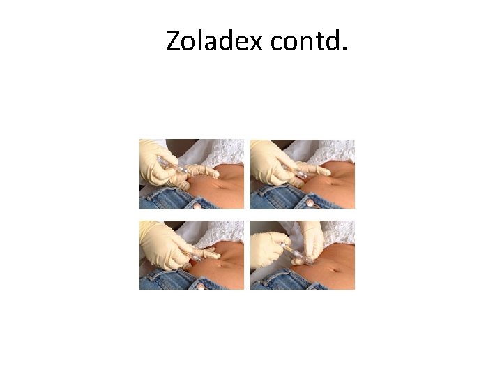 Zoladex contd. 